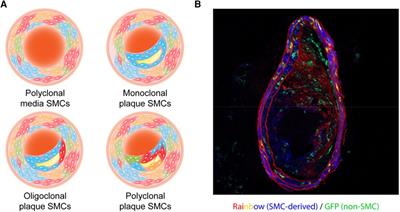 Role of vascular smooth muscle cell clonality in atherosclerosis